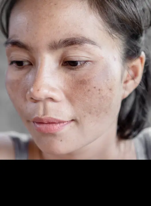 Dark Spots & Hyperpigmentation