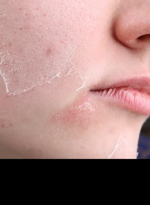 Dry & Dehydrated Skin